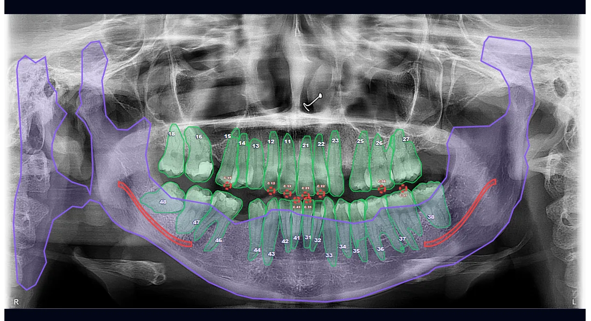 Imagem panorâmica odontológica demonstrativa analisada pela VATEX IA Panorâmica
